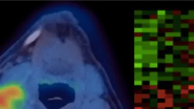 Head and Neck Cancer
